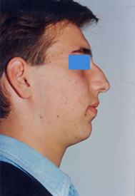 Chirurgia Estetica - Rinoplastica - foto prima dopo.